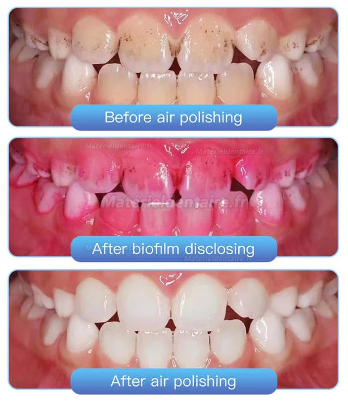 Aéropolisseur dentaire entièrement métalliques 2/4 trous